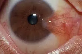 Pterygium Management in Thane service image