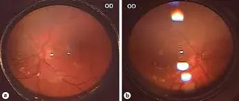 Retinal check up in Thane service image