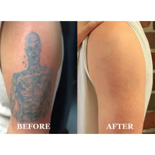 Tattoo Removal Treatment service image