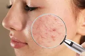 Acne Treatment service image