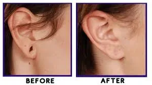 Ear Lobe Repair Treatment service image