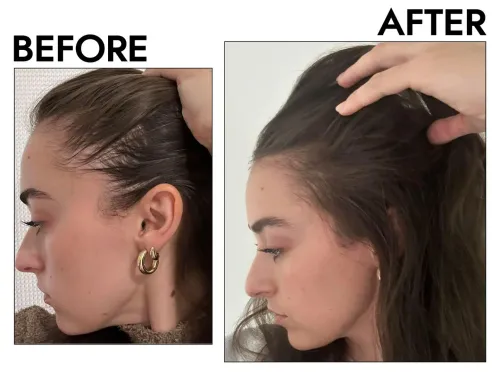 Hair Fall Treatment service image