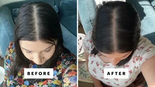 Hair Regrowth Treatment service image