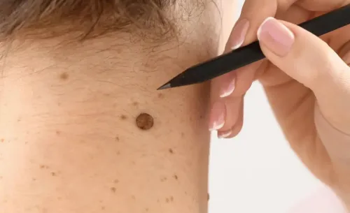 Warts & Moles Removal Treatment service image