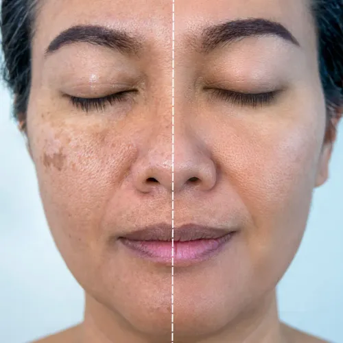 Chemical Peel Treatment service image