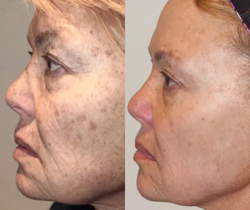 IPL Photo Facial Treatment service image