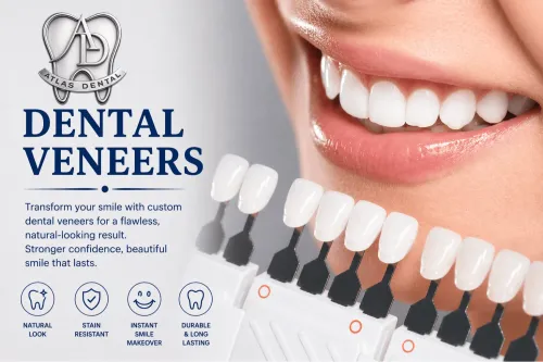 Dental Veneers service image