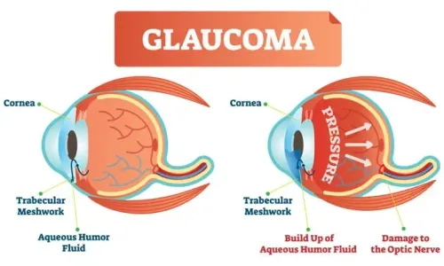  Glaucoma Treatment service image