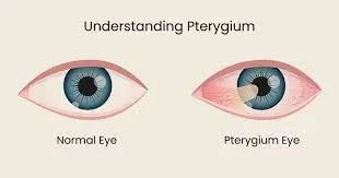  Pterygium Management service image