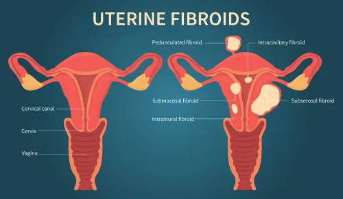 Fibroids Treatment service image