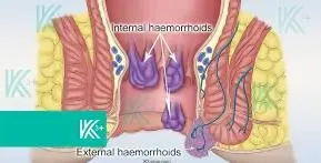 Laser treatment for piles (hemorrhoids) service image