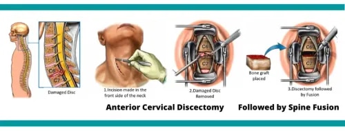 Anterior Cervical Discectomy And Fusion (ASDF) service image