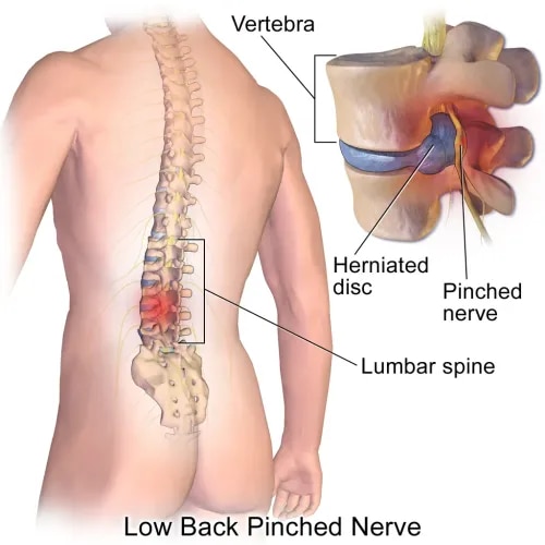 Microdiscectomy  service image