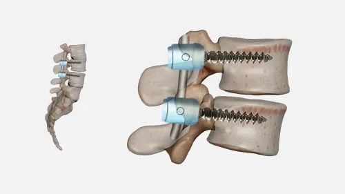 Spinal Fusion  service image