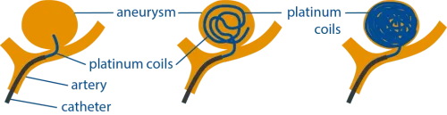 Endovascular Coilling/Clipping  service image