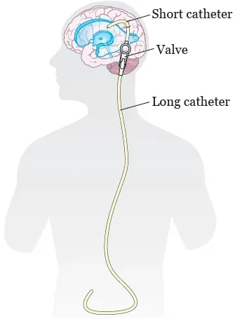 Ventriculoperitoneal (VP) Shunt  service image