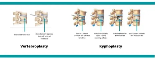 Vertebroplasty/Kyphoplasty  service image