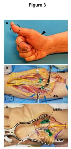 Peripheral Nerve Surgery  service image