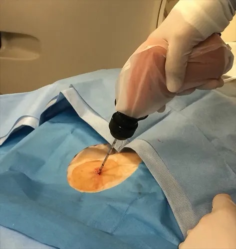Advanced Spine Biopsy Treatment for Accurate Diagnosis service image