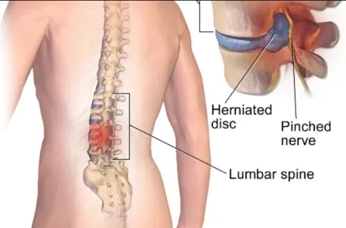 Microdiscectomy Surgery for Slip Disc & Sciatica Relief service image