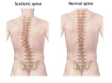 Advanced Spinal Deformity Correction Surgery In Jaipur  service image