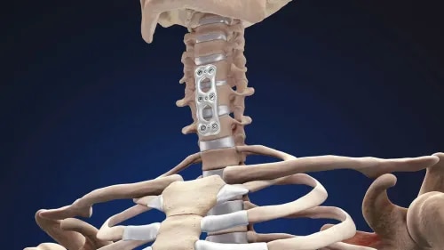 ACDF (Anterior Cervical Discectomy and Fusion): Modern Neck Spine Surgery service image