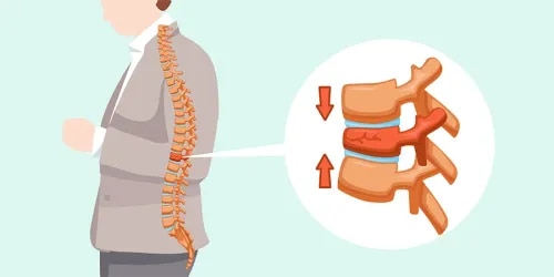 Spine Fracture Fixation Surgery For Spinal Stability  service image