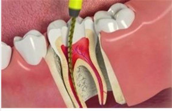 Root Canal
