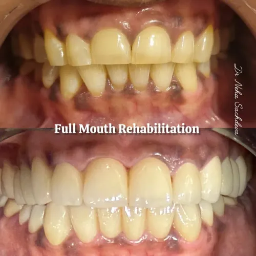 Full Mouth Rehabilitation service image