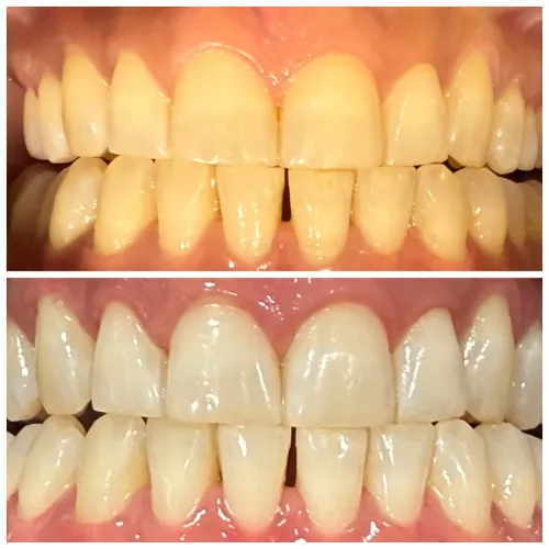 Teeth Whitening service image