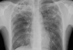 T.B. ,PNEUMONIA  service image