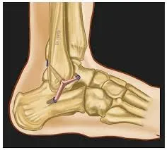 Tendon and Ligament Reconstruction service image