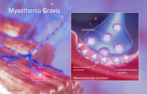 Myasthenia Gravis and Neuromuscular Junction Disorders service image