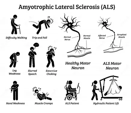Motor Neuron Diseases (including ALS) service image