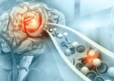 Stroke and Cerebrovascular Disorders service image