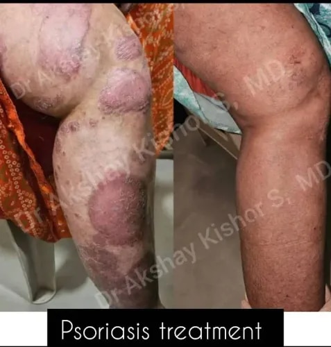 Psoriasis Treatment  service image