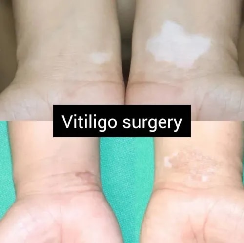 Vitiligo Treatment  service image