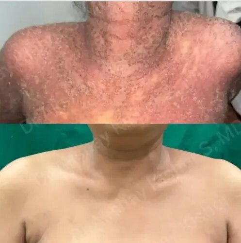 Eczema Treatment  service image
