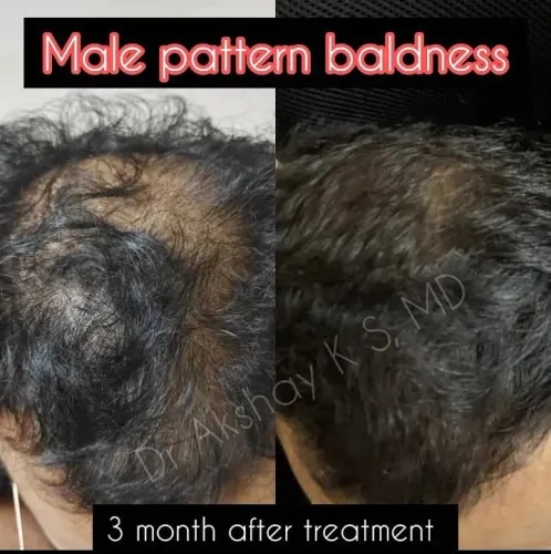 Male & Female Baldness & Hairfall Treatment  service image