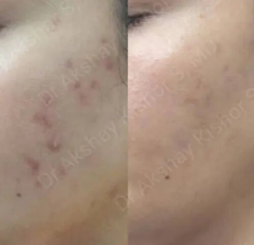 Acne And Acne Scars Marks Treatment  service image