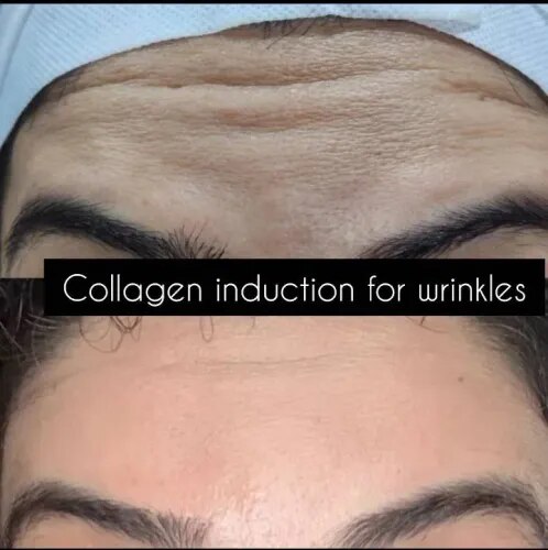 Wrinkles Treatment  service image