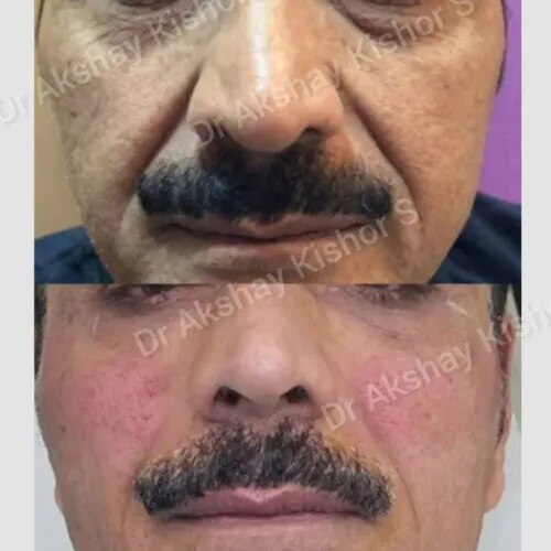 Skin Tightening Treatment  service image