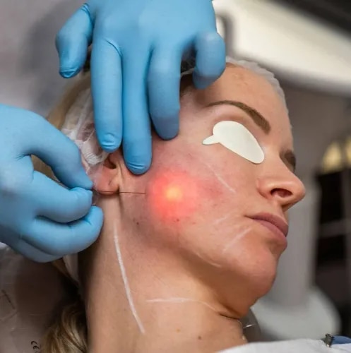 Endolaser (Endolift) Treatment  service image