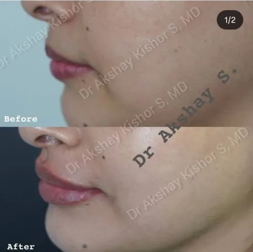 Lip Fillers Treatment  service image