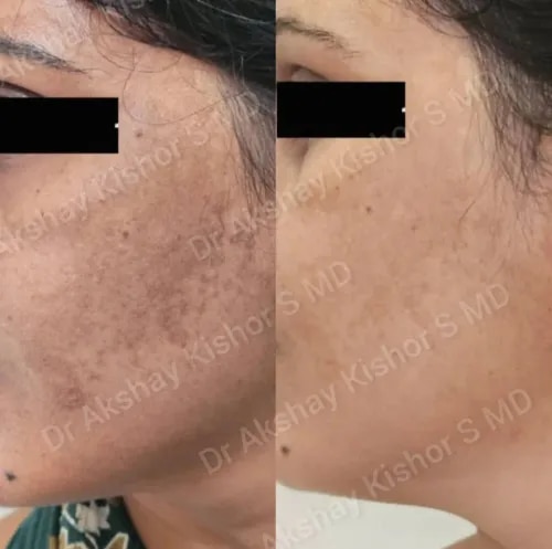 Melasma Treatment  service image