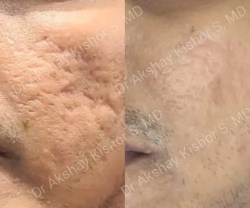 Acne Scars Treatment  service image