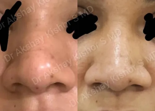 Non Surgical Rhinoplasty  service image