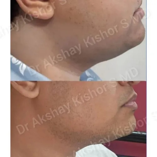 Non Surgical Double Chin Reduction  service image