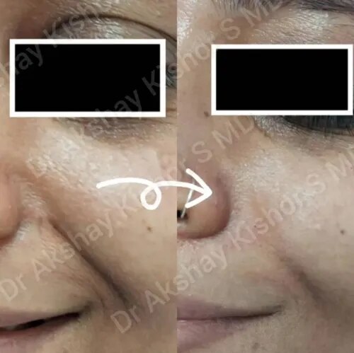 Nasolabial Fold Correction  service image