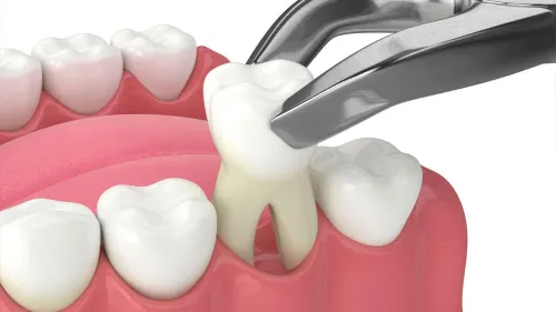 Extraction Treatment service image